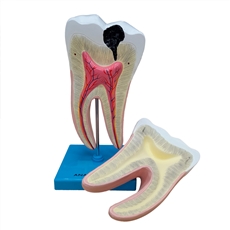 Dente Molar Ampliado - Saudável e com Cárie - TGD-0311-B