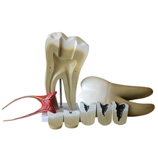 Dente Molar Ampliado com Evolução da Cárie, em 8 Partes - TGD-0311-G